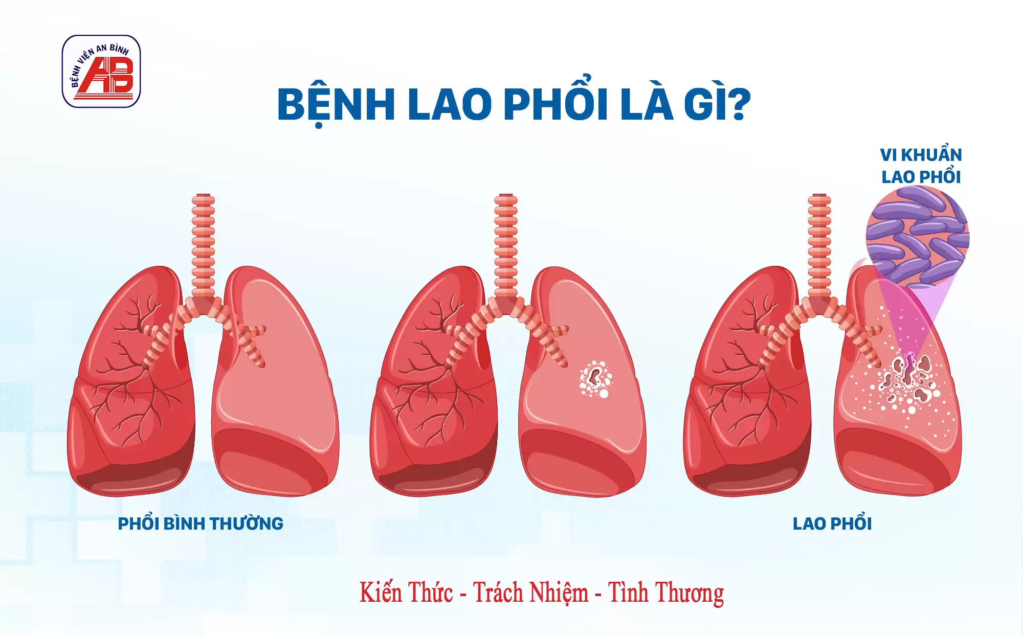 HƯỚNG ĐẾN MỤC TIÊU CHẤM DỨT BỆNH LAO VÀO NĂM 2030